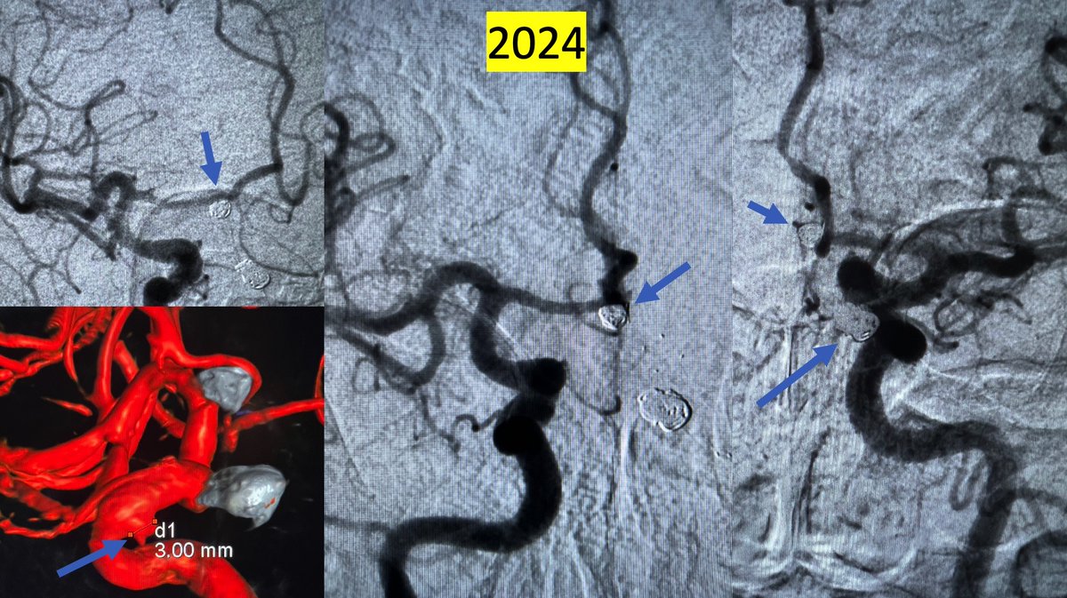 Neurointervention for Brain Aneurysms continue to confirm ISAT results in providing Long-Term Symptom Free Survival and Angiographic Occlusion/“Cure” of Brain Aneurysms (20yrs). Small low risk aneurysms can be monitored safely, tailored to each patient.
#neurointervention