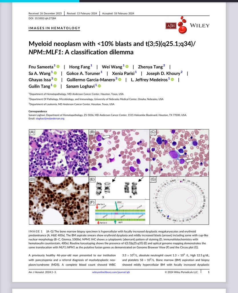 sanamloghavi's tweet image. Out today @AjHematology 
More reason I ♥️ NPM1 IHC…. 
When cytoplasmic &amp;amp; you don’t find a mutation… U should suspect NPM1 rearrangement
We argue NPM1-r myeloid neoplasms should be considered AML irrespective of blast %
Congrats to Dr. Sameeta 
#hemepath 
onlinelibrary.wiley.com/doi/epdf/10.10…