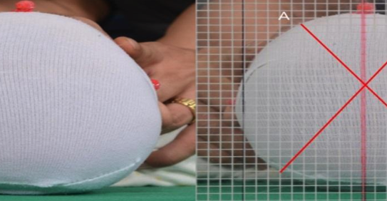 PPODhelmet's tweet photo. A new article published in the Journal of Craniofacial Surgery dives deep into the world of plagiocephaly, shedding light on the effectiveness of helmet therapy for cranial deformations based on cranial shape. 

https://t.co/wTRByJ7EPF

#Plagiocephaly #HelmetTherapy https://t.co/XITNZ0cmhd
