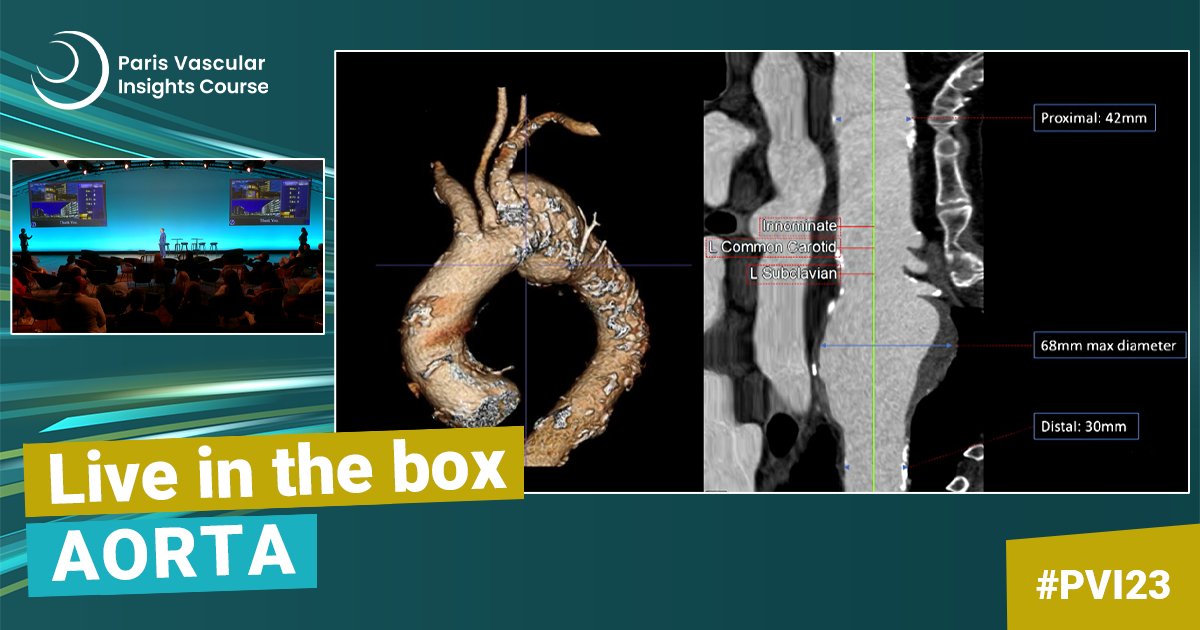 Explore this aorta-focused session to learn more about innovative approaches to aortic interventions, such as transcatheter electrosurgical septotomy, type B dissection repair, conversion post-endograft completion. #endovascular #vascular
Learn more 👉 ow.ly/phPs50QLvJx