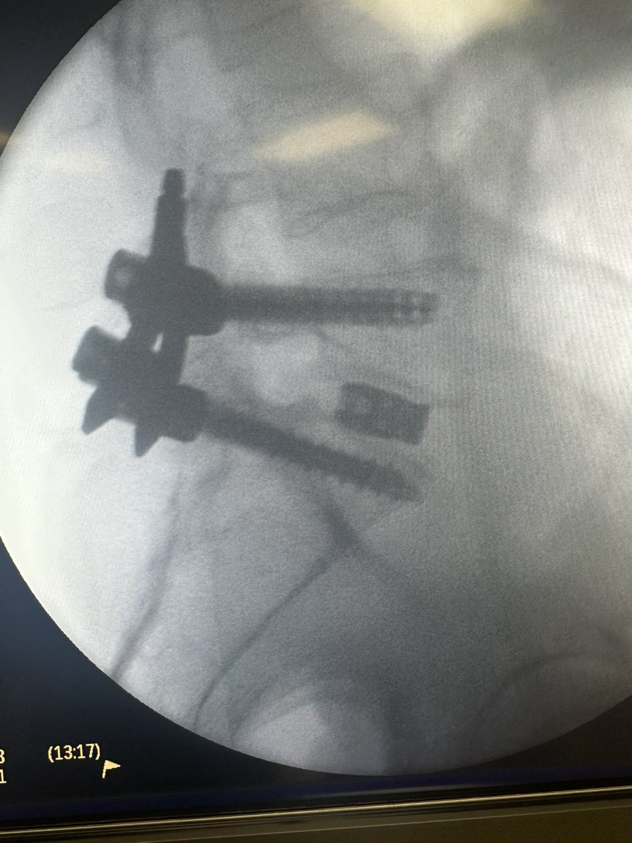 I still love TLIFs for spondy…. In this case it was done MIS/pedicle based retractor 
2 hours, patient went home same day… 
I did use BMP

#MedTwitter #spinesurgery #Neurosurgery #orthotwitter