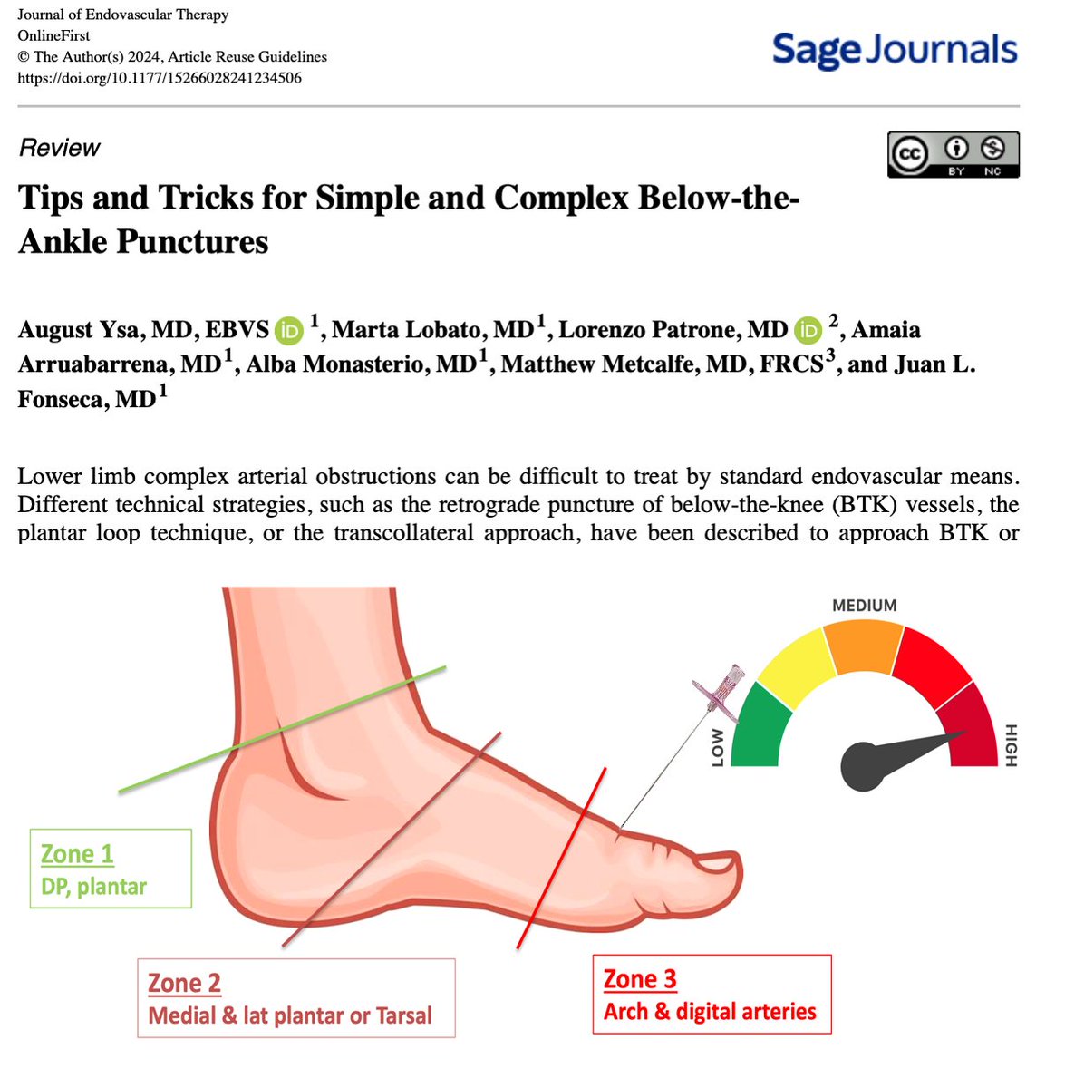 Hot off the press! TIPS & TRICKS for simple and complex BTA PUNCTURES 🆓 at doi.org/10.1177/152660… Feel free to 👍🏻 or 🔁 it among your colleagues or fellows! @Vascupedia_com @_backtable @CLI_Global