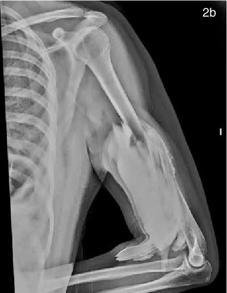 Compartment syndrome after IV contrast extravasation.