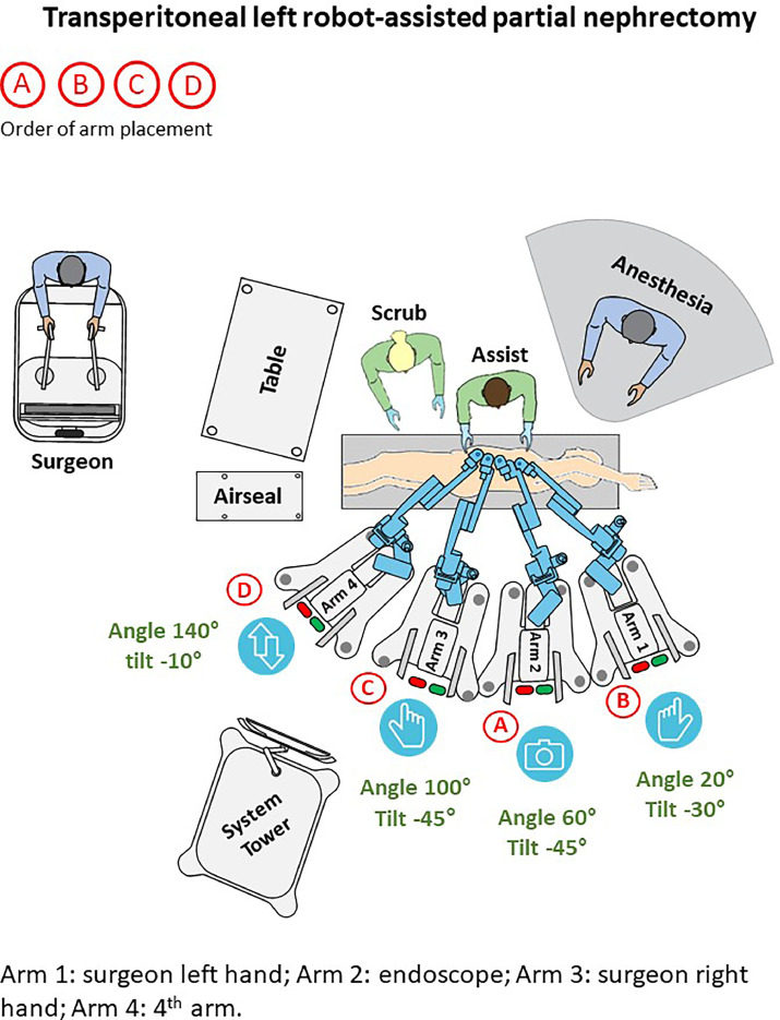 New research online from Urology Video Journal Transperitoneal and retroperitoneal robot-assisted partial nephrectomy with the Hugo™ RAS system: Video instructions and initial experience from a tertiary care referral centre Read now: spkl.io/60114I1Hb