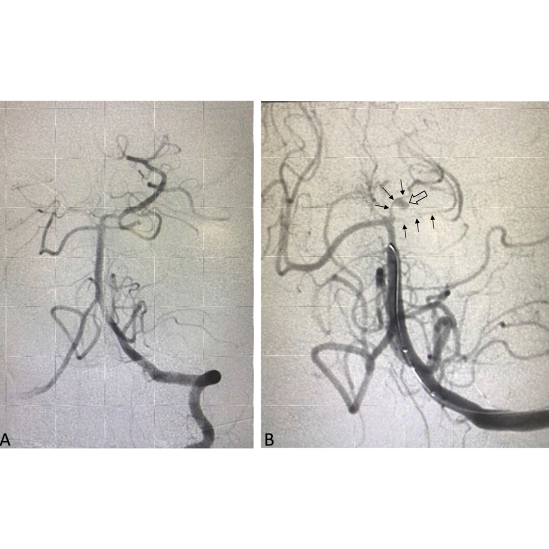 🧠 New study sheds light on fungal meningitis outbreak linked to epidural anesthesia in Mexico. Descriptive analysis reveals insights into neuroendovascular observations and treatment strategies at a US-Mexico border stroke center. Read more in <a href="/JNIS_BMJ/">JNIS</a> bit.ly/49Icfcb