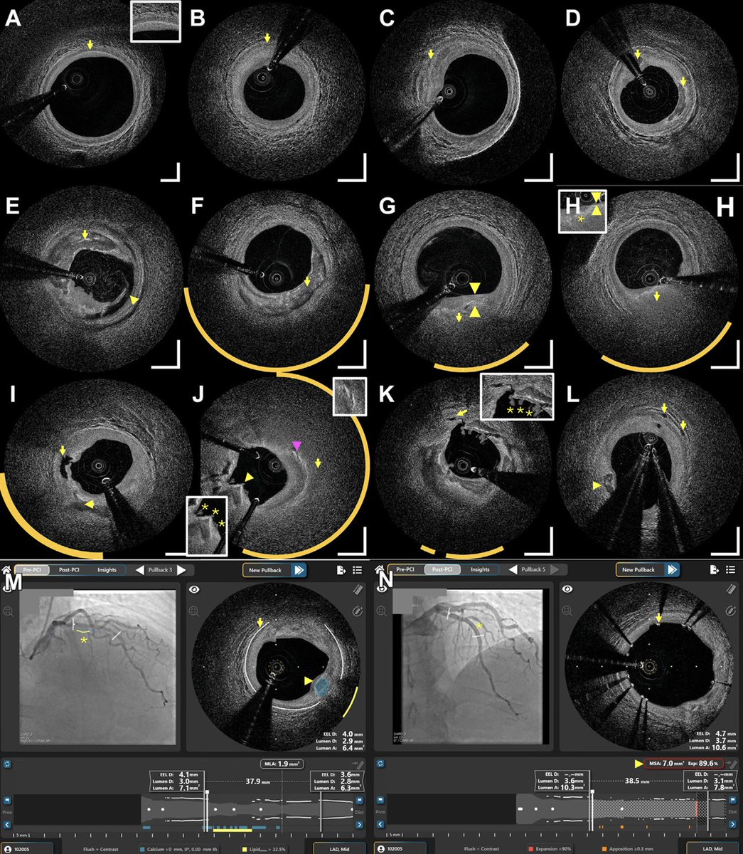 Just publ in JSCAI our first-in-human study with a new integrated AI-enabled OCT-NIRS imaging catheter that has enhanced resolution and IVUS-like depth penetration (even better in calcium). Angio co-reg w/ automated EEM, lipid and Ca detection. Free link: authors.elsevier.com/sd/article/S27…