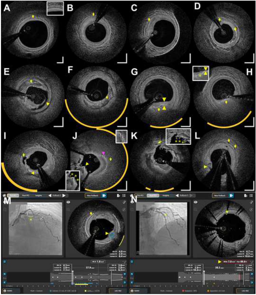 🗣️📢Presented at #SIF2024 - FIH experience w novel multi-modality #DEEPOCT #NIRS intravascular imaging system including image comparisons to #OCT & HD-IVUS. #ImageFirst

➡️doi.org/10.1016/j.jsca…

@ziadalinyc @GreggWStone @DrJMHill @DrChuckSimonton