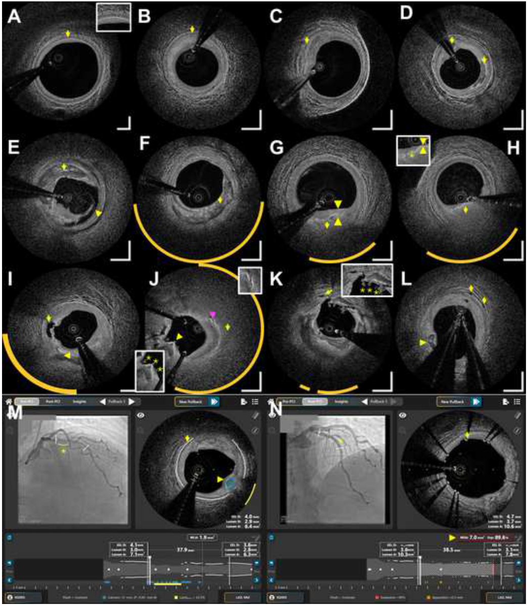 MyJSCAI (@myjscai) on Twitter photo 🗣️📢Presented at #SIF2024 - FIH experience w novel multi-modality #DEEPOCT #NIRS intravascular imaging system including image comparisons to #OCT & HD-IVUS. #ImageFirst
➡️doi.org/10.1016/j.jsca…
<a href="/ziadalinyc/">Ziad Ali</a> <a href="/GreggWStone/">Gregg W. Stone MD</a> <a href="/DrJMHill/">Jonathan Hill</a> <a href="/DrChuckSimonton/">Chuck Simonton</a> 🗣️📢Presented at #SIF2024 - FIH experience w novel multi-modality #DEEPOCT #NIRS intravascular imaging system including image comparisons to #OCT & HD-IVUS. #ImageFirst
➡️doi.org/10.1016/j.jsca…
<a href="/ziadalinyc/">Ziad Ali</a> <a href="/GreggWStone/">Gregg W. Stone MD</a> <a href="/DrJMHill/">Jonathan Hill</a> <a href="/DrChuckSimonton/">Chuck Simonton</a>