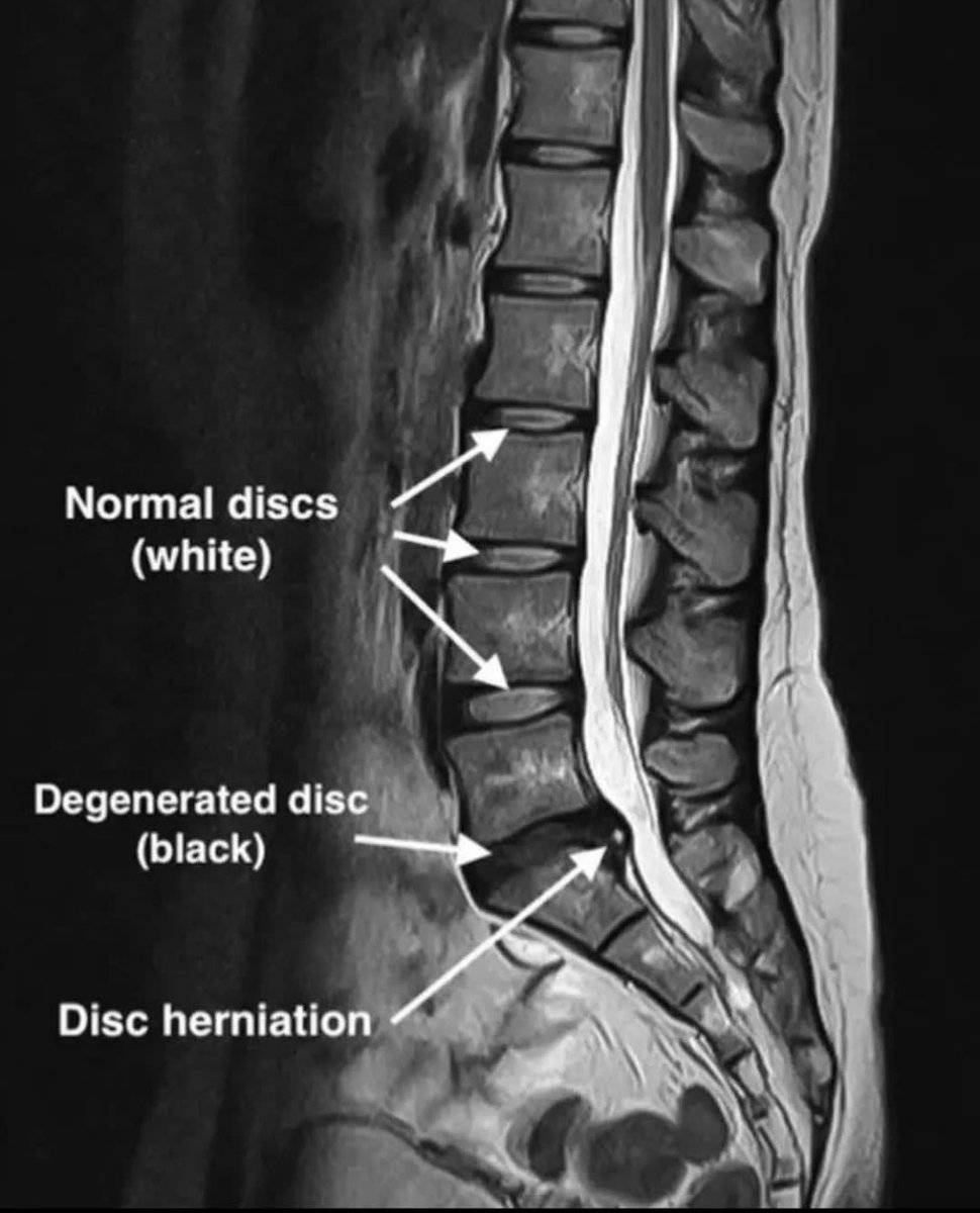 t_blinkx's tweet image. As a diagnostic radiographer, I see it an essence to share this L spine MRI image
#mri #Radiology
