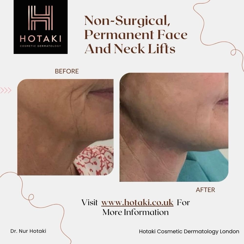 #drhotaki #hotakilondon #nonsurgicalaesthetics #aesthetictreatment #hotakicosmeticdermatology #noninvasive #nonsurgical #nonsurgicallowerfacelift #nonsurgical #nonsurgicalfacelift #facialrejuvenation #lowerfacelift #necklifts #nonsurgicalnecklifts #permanentnectlifts