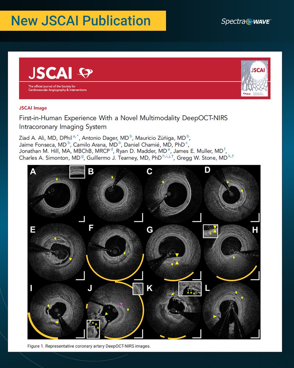 NEW IN #JSCAI: Publication highlighting clinical experience and unique value of the HyperVue Imaging System featuring #DeepOCT+NIRS intravascular imaging in a variety of plaque morphologies. Congratulations to all the authors! Learn more here: jscai.org/article/S2772-…