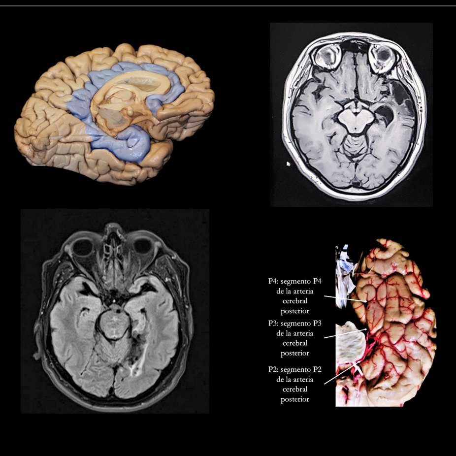 JRBneuropsiq's tweet photo. In the approach to cognitive disorders, we need an understanding of structural &amp; functional connectivity

Case 1: TBI leads to a lesion of the temporal pole, the amygdala &amp; the hippocampus. Outcome? Antegrograde and retrograde amnesia, affecting the declarative, episodic memory https://t.co/MdGXNzfhQi