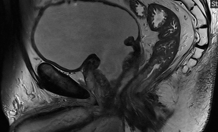 Photogenic view (3T MRI) of a formerly 160 ml prostate 3 months after HoLEP done to follow up a prostate cancer on active surveillance. Few lessons: 
⭐️yes, treating symptomatic BPH in men on AS surveillance is feasible.
⭐️Treating BPH can decrease PSA and diagnostic burden in