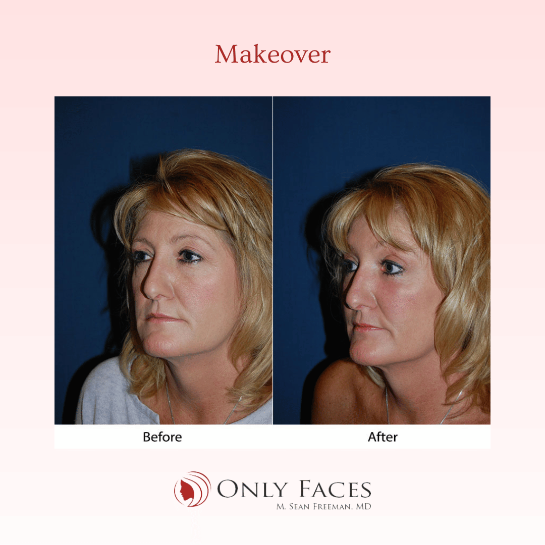 OnlyFacesCLT's tweet photo. This 55-year-old is post-op from a Segmental Endoscopic #BrowLift: 3/4-R/L, Lower lid: SOOF lift #blepharoplasty, and Ablative CO2 laser resurfacing of the eyes and mouth and for Rosacea. #OnlyFaces https://t.co/SCUB0dcqKk
