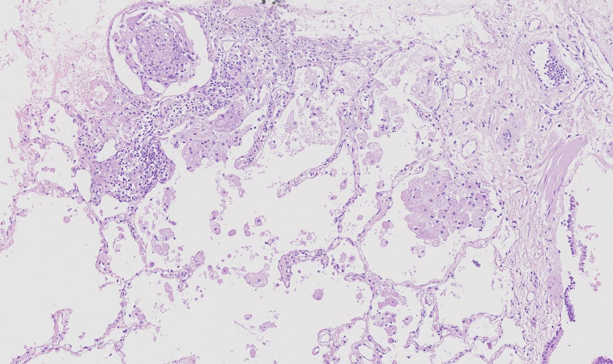 F,60+, Alveolar proteinosis,trans-bronchial lung cryobiopsy.
Alveoli contain amorphous  granular eosinophilic proteinaceous material  (PAS+).
Lung architecture preserved.
Ninimal inflamation, foamy macrophages
1/2
🧵⬇️