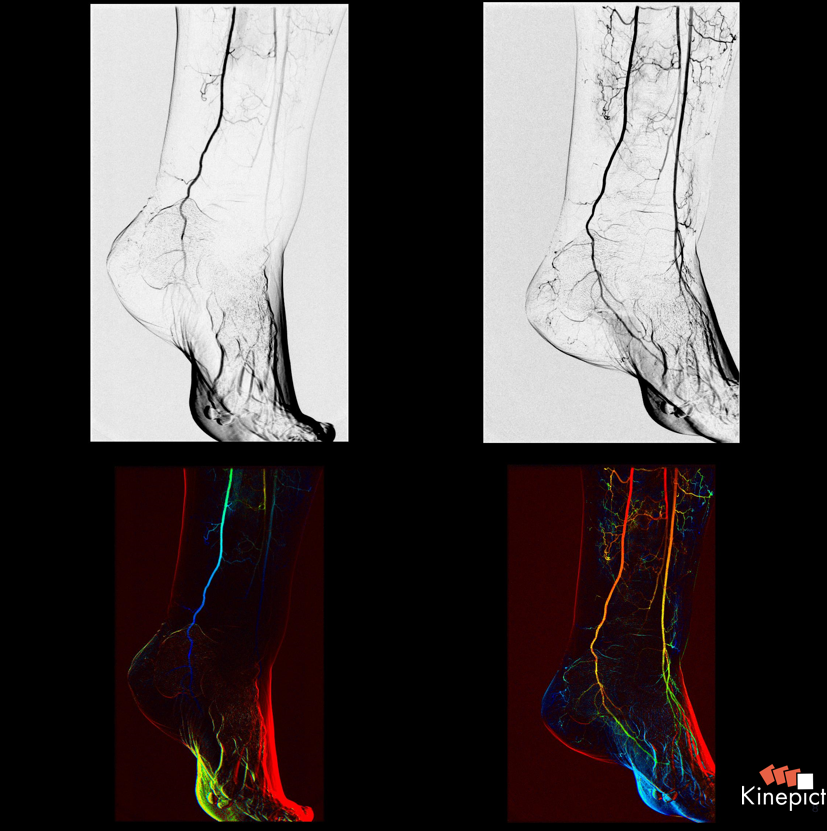 Our innovative technology empowers clinicians to make precise decisions instantly in the fight against amputation in Chronic Limb Threatening Ischemia (CLTI) patients.  

#kinepict #innovationinimaging #healthcaretechnology #savelimbssavelives #medicalimaging #xrayangiography