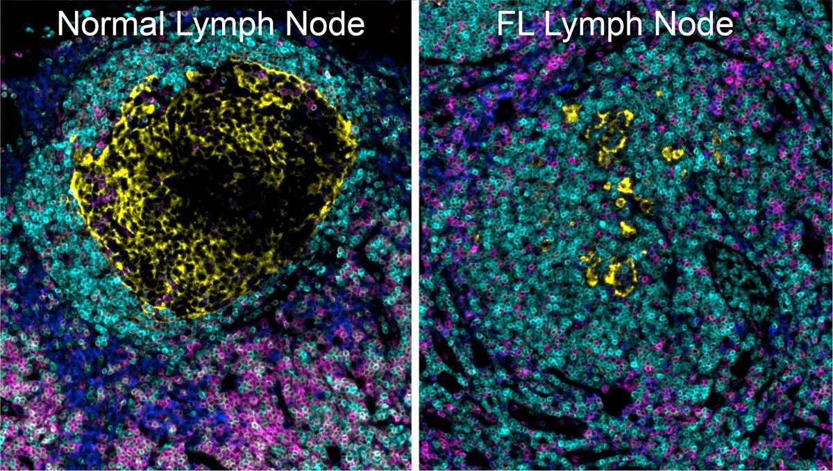 #NIAID and #NCI scientists identified distinguishing features and patterns in the tumors and lymph-node tissue of people with #FollicularLymphoma who relapsed within 24 months. The findings could help predict early relapse and inform treatment decisions. doi.org/10.1016/j.ccel…