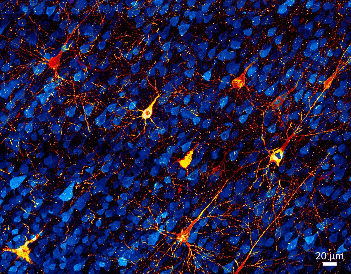 Dying neurons accumulating phospho-tau in #Alzheimer 
Why phosphorylated tau can be harmful? Because it accumulates inside the neuron, disrupting the microtubule system and impairing axonal transport and synaptic activity.
The image below from our monkey model of Alzheimer shows