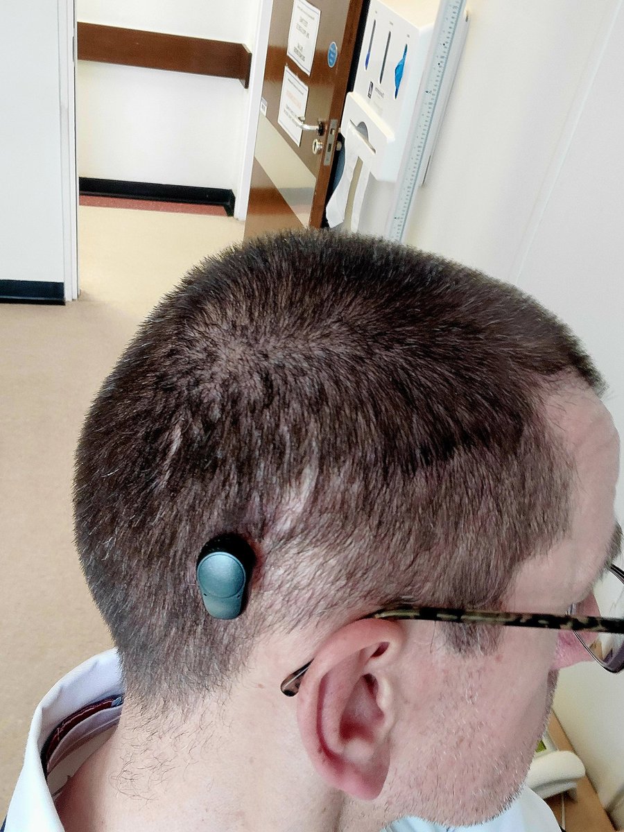BahaNick16's tweet photo. @Mel_Pickup @RespPhysLTHT 🤷♂️ just seasonal wear & tear? Made it to SJUH complete with new @OticonMedical #ponto5🦻 thank you @AudiologyBthft especially Sue x https://t.co/V3o1CttqVi