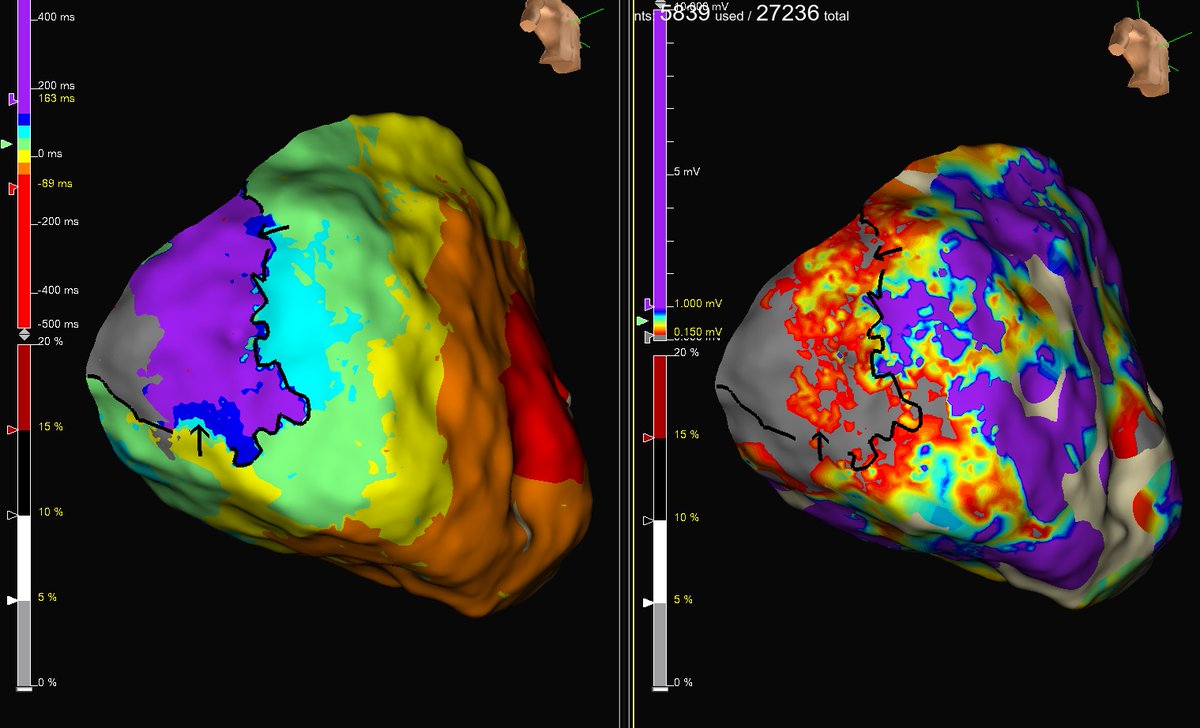 Electrical storm in a pt with AMC. Epicardial line of block and DZ RV basal area.@SteliosDragasis @ipetemil @athsaplaouras @Kariki_O @BellosPeriklis #OnassisCardiacSurgeryCenter