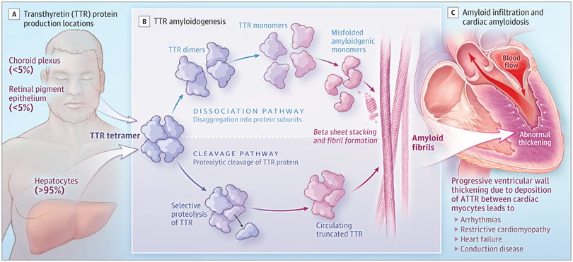 SeguraCardio's tweet photo. 📌Cardiac #Amyloidosis Due to Transthyretin Protein

#Review #CardioEd https://t.co/8f3cBqKhga