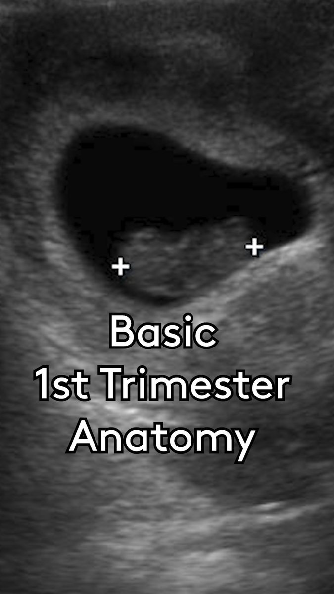 Basic Pelvic Anatomy for 1st Trimester Ultrasound youtu.be/eaG7nPB-LA4 #POCUS #Ultrasound #OBGYN #OBUltrasound #metroEUS