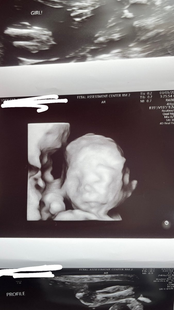 Our beautiful miracle baby🥹💗
I can’t wait till tomorrow I’ll get better pictures of her 3D ultrasound🥰
#rainbowbaby
