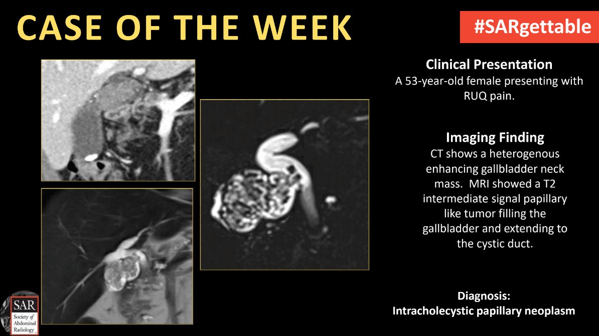 The answer to last week's #SARgettable Case of the Week, contributed by @AndreaEsqXR is: Intracholecystic papillary neoplasm. Thanks for playing!