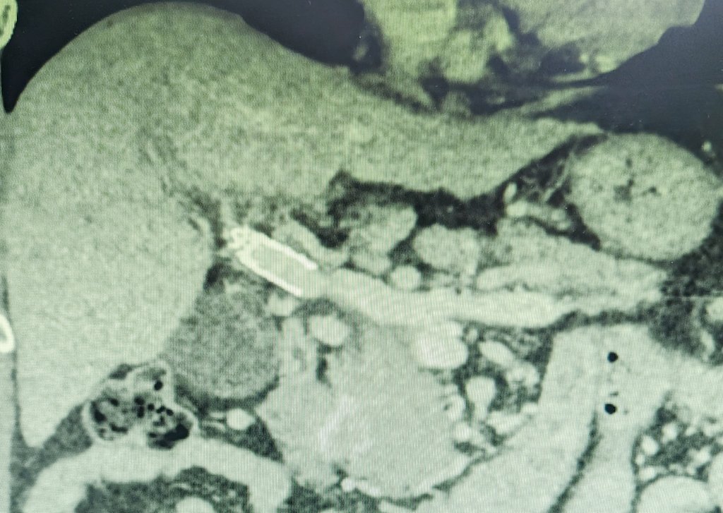 Mark Lessne, MD (@lessnevir) on Twitter photo Life-changing, life-saving #IRad procedure for those willing to take it on
No more ascites
No more bleeding
Walking 4 miles a day
"I feel totally healthy again"
Trans-splenic #PVRTIPS w SMV recan: do it!
<a href="/SIRspecialists/">Society of Interventional Radiology</a> #Liver #GITwitter Life-changing, life-saving #IRad procedure for those willing to take it on
No more ascites
No more bleeding
Walking 4 miles a day
"I feel totally healthy again"
Trans-splenic #PVRTIPS w SMV recan: do it!
<a href="/SIRspecialists/">Society of Interventional Radiology</a> #Liver #GITwitter