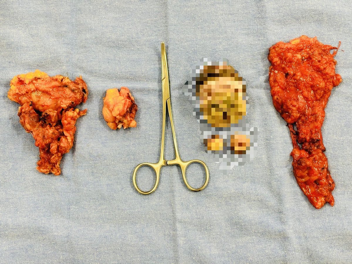 Penectomía parcial y linfadenectomia inguinal bilateral con el UroTeam <a href="/HgeSonora/">Hospital General del Estado de Sonora</a> 😎