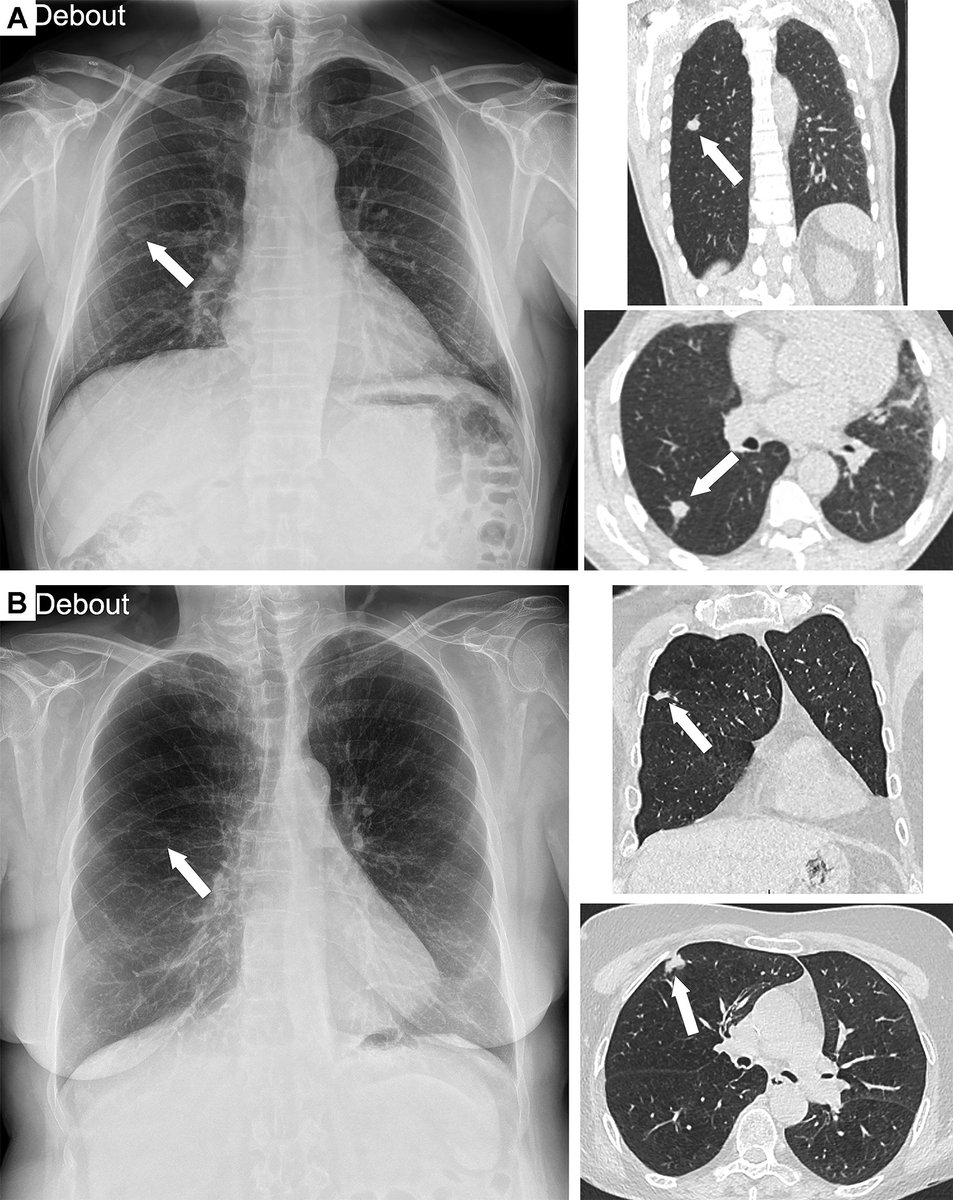 Despite the increasing use of CT and MRI, chest radiography remains the most performed radiologic examination worldwide. Read the full article, “Using AI to Improve Radiologist Performance in Detection of Abnormalities on Chest Radiographs” bit.ly/49EzdB5 <a href="/radiology_rsna/">Radiology</a>