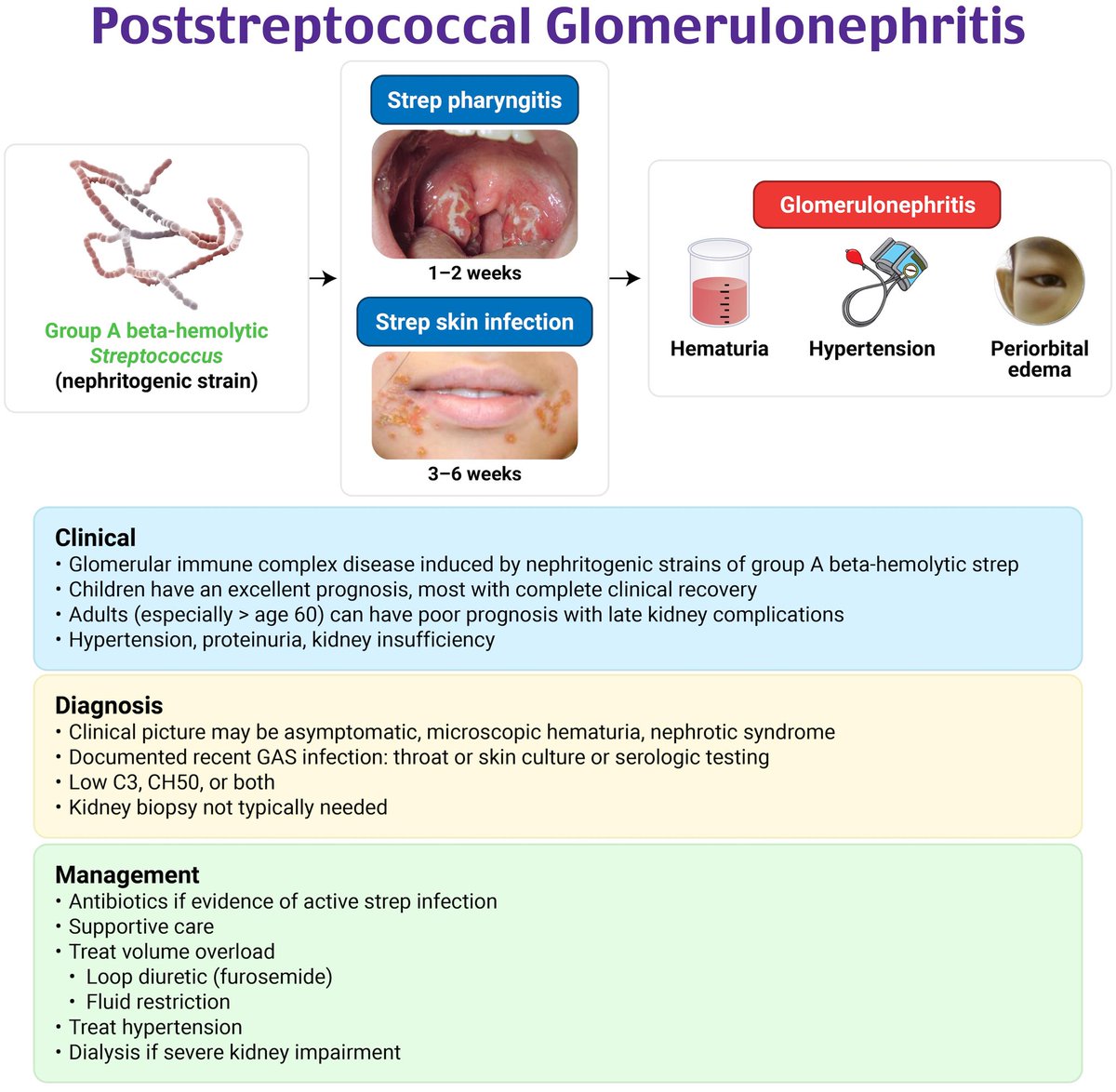 Post-streptococcal Glomerulonephritis (PSGN) 📖 By: Rosh Review #Pediatric #Nephrology