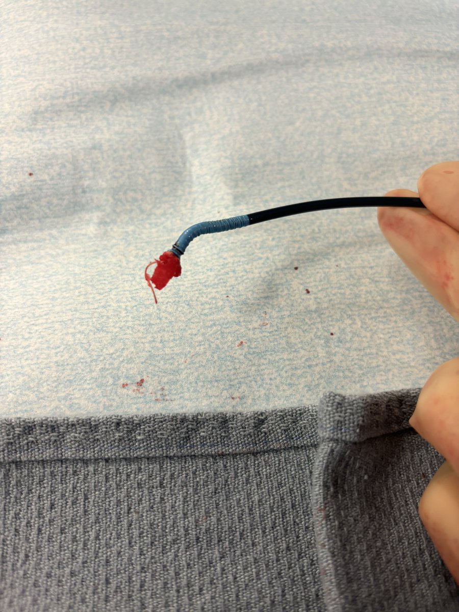 Angioseal plug deployed into the artery causing stenosis; successfully retrieved using a clover snare. Note the deployment suture still attached to the collagen plug. #MedTwitter #irad #twittIR