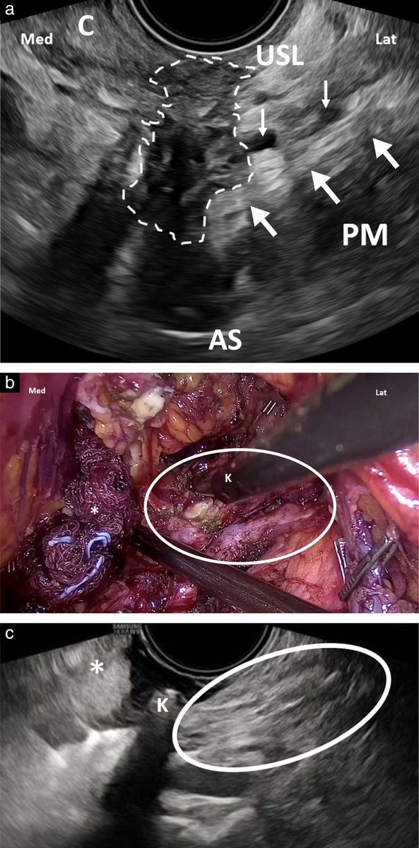 @GynaecologyUS @nancynursez637 @AmandaB55744931 @shaheenkhazali Yes. Deep endometriosis affecting the sacral plexus can be visualized with TVS . Sonographic characteristics of these lesions are detailed in our new accepted paper, in the White Journal. obgyn.onlinelibrary.wiley.com/doi/10.1002/uo… An image from our previous article: obgyn.onlinelibrary.wiley.com/doi/10.1002/uo…