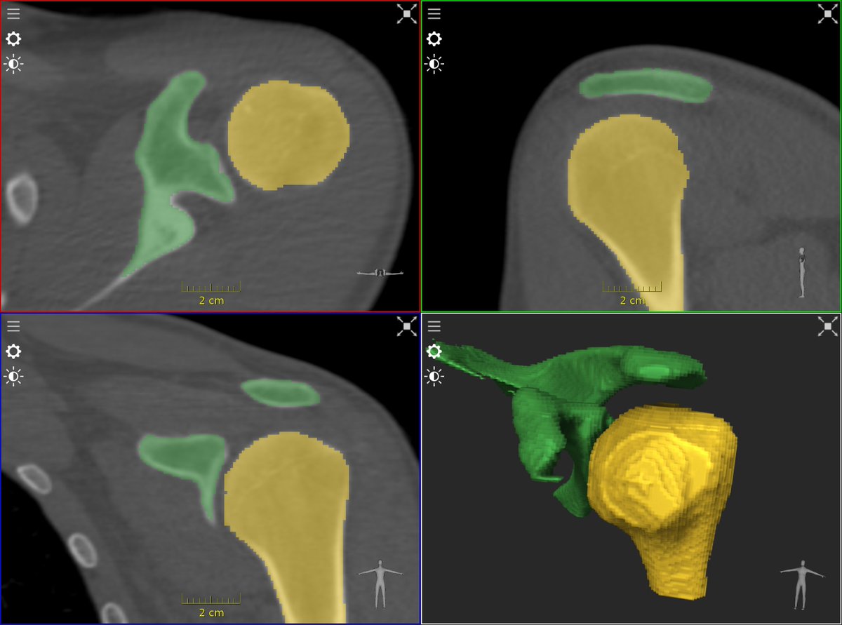 ImFusionGmbH's tweet photo. 🔍 Case study: Shoulder Instability Treatment Transformed by ImFusion's Expertise!

Shoulder instability diagnosis is complex. Dr. Moroder &amp; team aimed to revolutionize care by maximizing diagnostic value from existing imaging techniques.

🧵1/2 https://t.co/lg6jLZhKNy