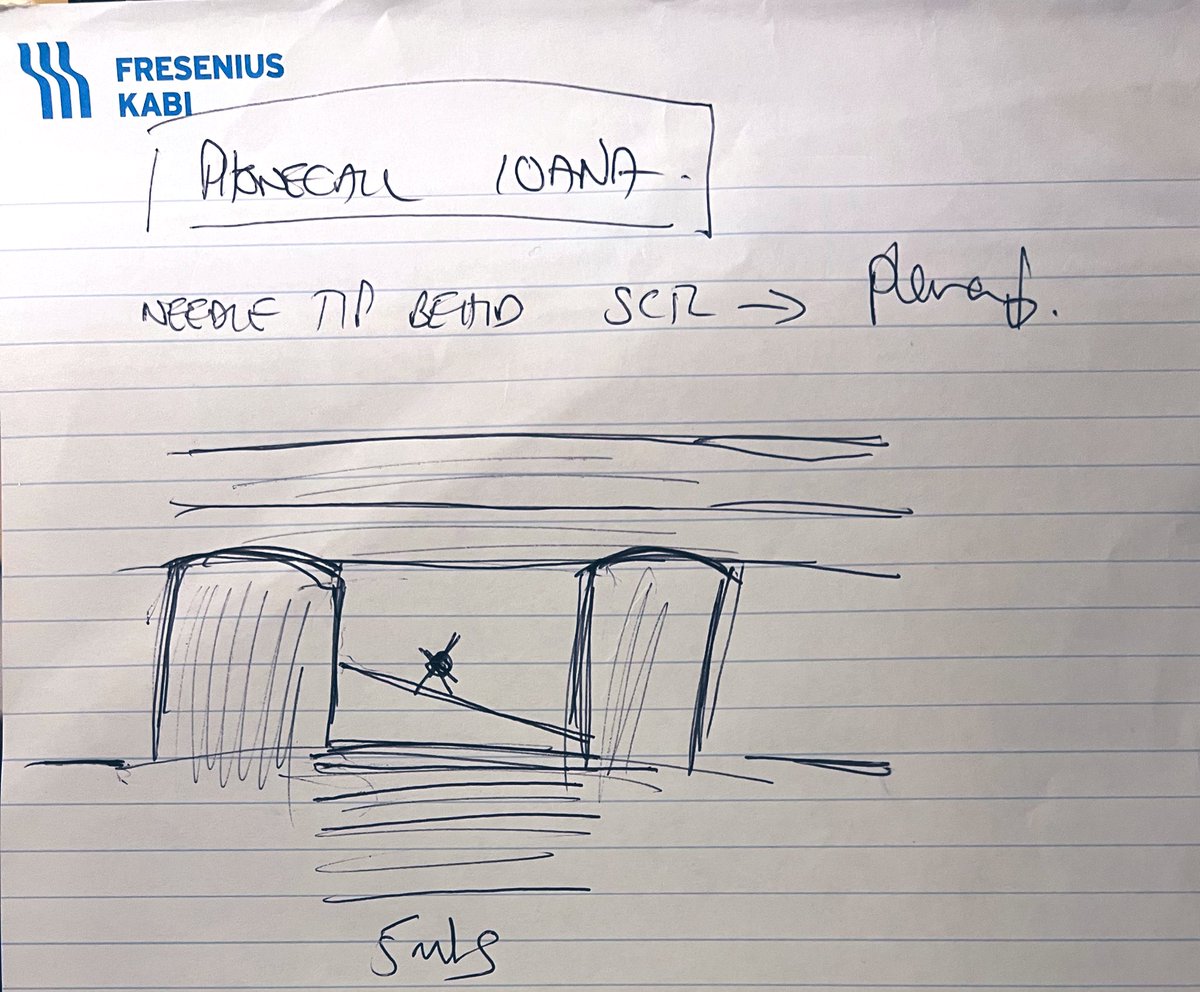 Doing a little bit of tidying up and came across this memory from late 2016! This was the doodle I did while on a video call with @IcostacheIoana and was the beginning of the paper on #MTP block, now called the #ITP block! #RegionalAnaesthesia #BILIH …-publications.onlinelibrary.wiley.com/doi/10.1111/an…