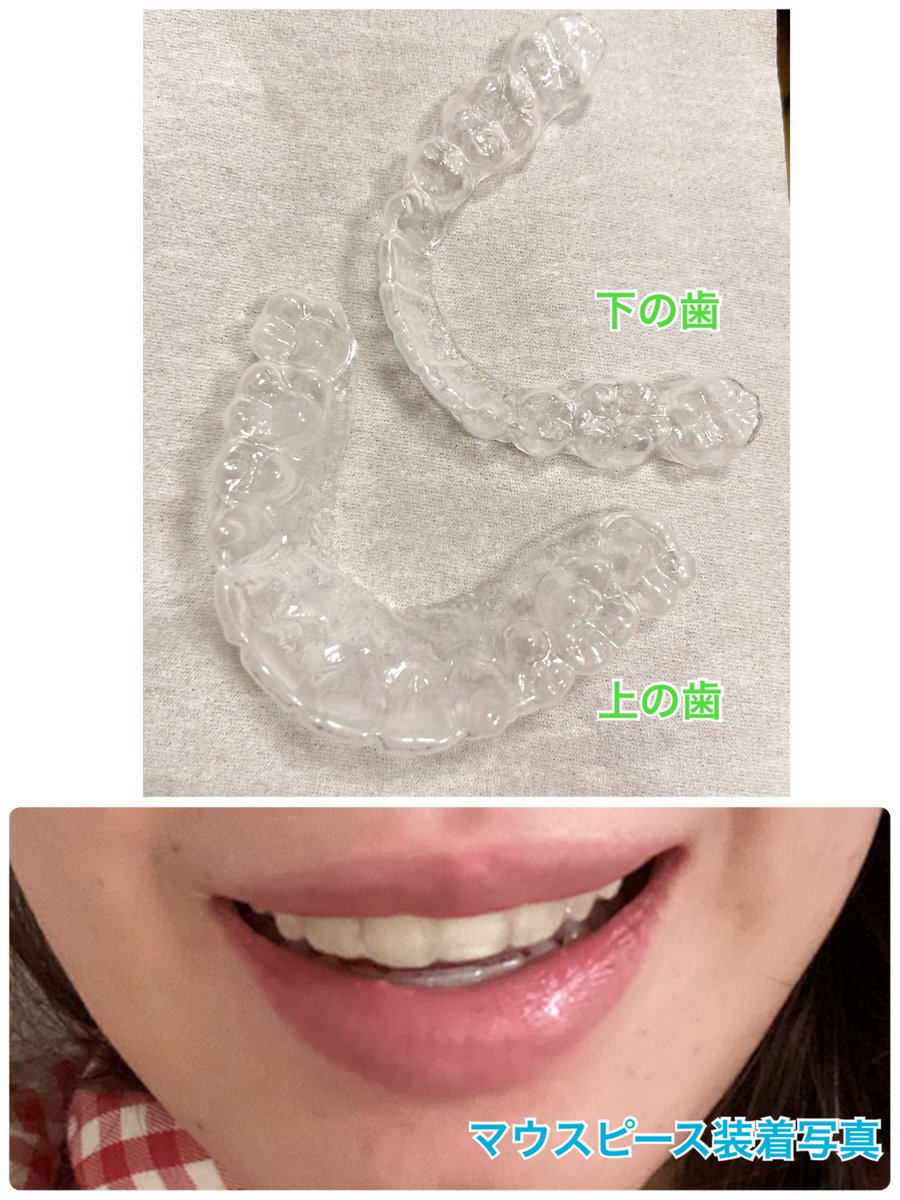🦷リテーナーの紹介
⭐️クリアリテーナー（マウスピース）
・目立たない
・唯一飲食できるのは水のみ（お茶も大丈夫だけど着色する）でほぼ飲食❌、飲食したら歯磨き必須（虫歯になる）
・付けてると歯が噛み合わないから、外すと噛み合わせが迷子になる（私だけ？）
・虫歯治すと入らなくなる