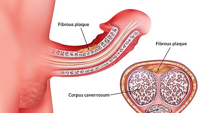 Plication surgery does not produce additional loss of length in #PeyroniesDisease patients 👉 rdcu.be/dzpPx @giuliogaraffa @fanfa92 @FraClaps @Nicp85Pavan @GiulioRossin @unipa_it @Piase6 @MicheleRizzo85 @biasanna94 @FZorzi @Trombetta_Carl @gioliguori33 @ongarluc_1991