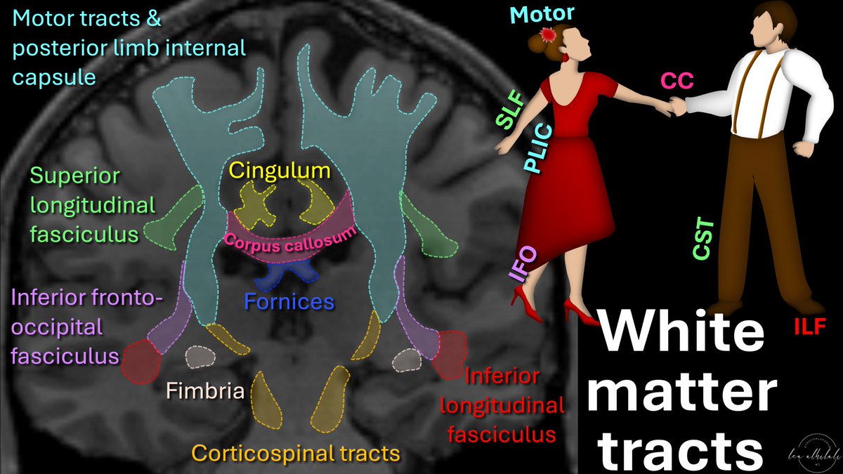 Looking for a white knight to help you remember white matter anatomy?

Do questions about white matter make you turn white as a ghost?

Well, here’s a white-hot way to remember it!

Coronally, major white matter tracts look like 2 people dancing—can you see it?

Let me explain!