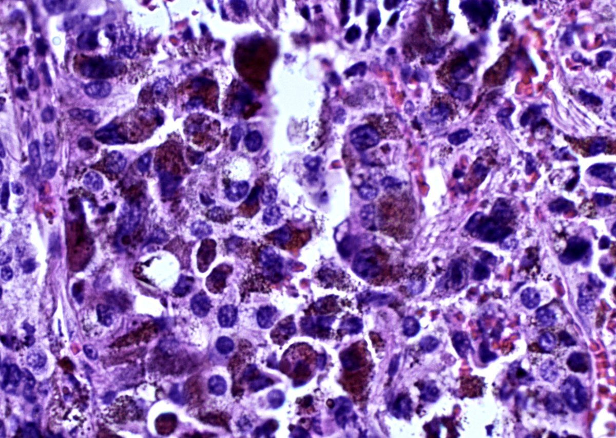 Regular day, looking at this choroid plexus papilloma and then…MELANIN! Do you know why this happen? Does it interferes with the prognosis? #pathTwitter #pathology #pathresidents #neuro 🔬 🧠