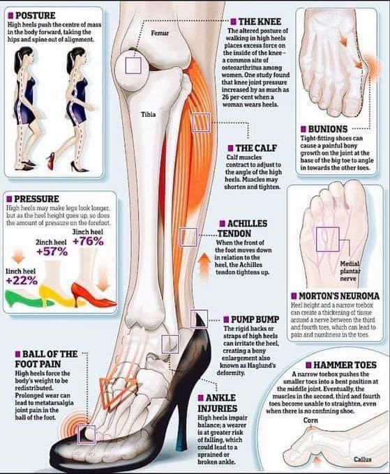 High heels 👠 can cause few problems! 
I am sharing this infographic to rise your awareness about such potential problems.

#highheels #Footpain #anklepain