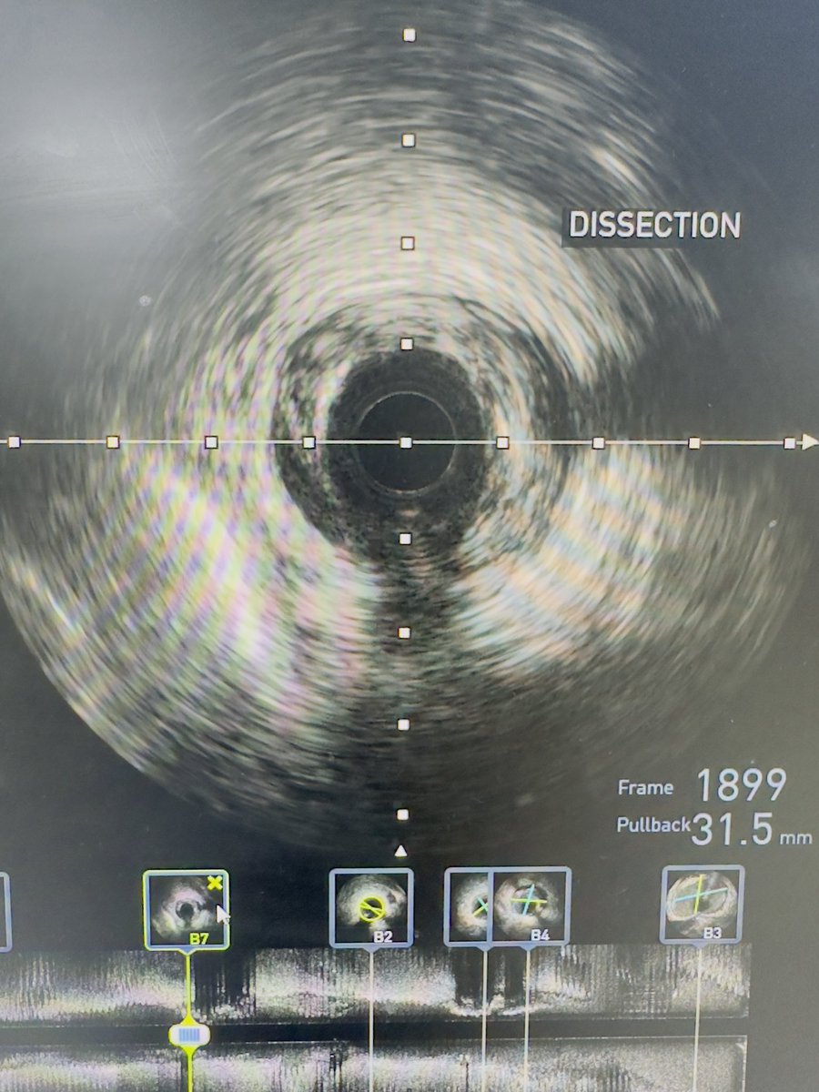 IVUS helps us eliminating guesswork in decision making process.

Diffuse LAD lesion. After pre-dilatation, angiography show no flow distally.

Conducted an IVUS ➡️ dissection revealed  ➡️ we treated with stenting.

Flow restored, good final result 😇

#interventionalcardiology