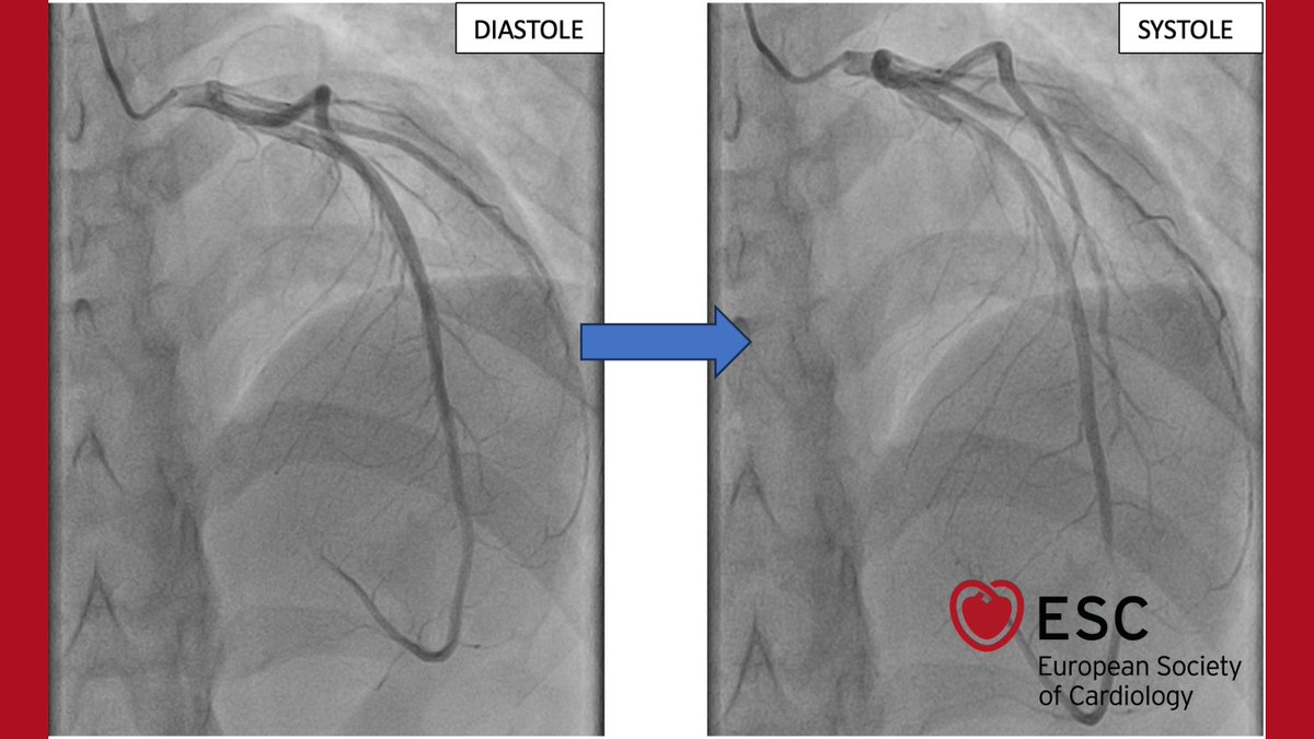 #ImageOfTheWeek by Raid Faraj, Nouhaila Lahmouch and Jamila Zarzur, from the Cardiology B department, Ibn Sina university hospital, Mohammed V university, Rabat, Morocco, sent this question: 

A 26-year-old male, with a history of anabolic steroid use, presents with chest pain.