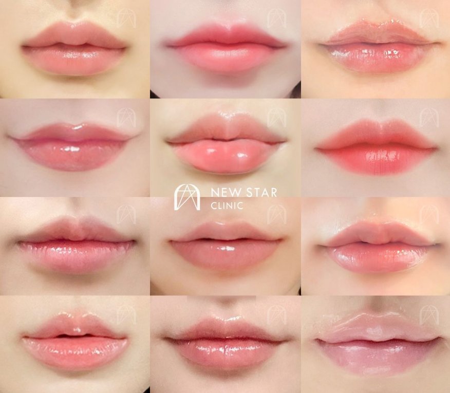 newstar_jp's tweet photo. ⭐人々がニュースターの唇フィラーを好む理由は？⭐

➊.上と下の唇に合う最適な比率で施術

➋.唇のタイプに合うフィラーの種類をおすすめ

➌.自然な唇と口角のデザイン

➍.本人の顔に似合う唇の形でカウンセリング後に施術

💯１００点満点の綺麗な唇をお望みならフィラー王国デザインフィラー、ニュースタークリニックで！

#額フィラー #唇フィラー #口角フィラー 
#口角ボトックス #おでこフィラー 
#整形垢 #韓国美容整形 #韓国整形 
#口角フィラー #ヒアルロン酸 
#美容整形 #渡韓整形