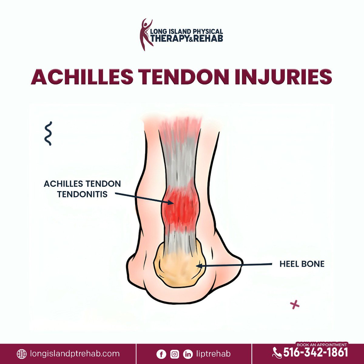 The Achilles tendon, a crucial connector between your calf muscle and heel, is the powerhouse behind your ability to move smoothly. 🏃‍♂️🦶

#achillestendon #plantarfasciitis #achilles #achillestendonitis #physicaltherapy #podiatry #podiatrist #achillesrehab