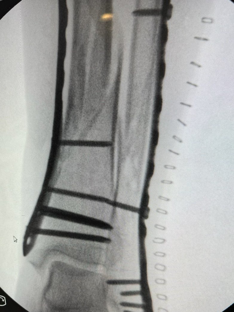 DraIsaGuillen's tweet image. 💥Fractura de #tibia y peroné:
🥼Paciente operada con reducción y síntesis con placas puente con técnica #MIPO mínimamente invasiva

@ClinicaCEMTRO