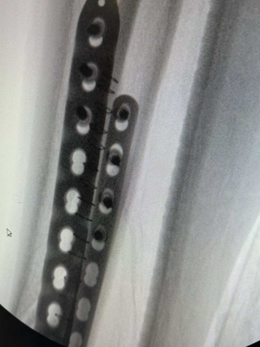 DraIsaGuillen's tweet image. 💥Fractura de #tibia y peroné:
🥼Paciente operada con reducción y síntesis con placas puente con técnica #MIPO mínimamente invasiva

@ClinicaCEMTRO