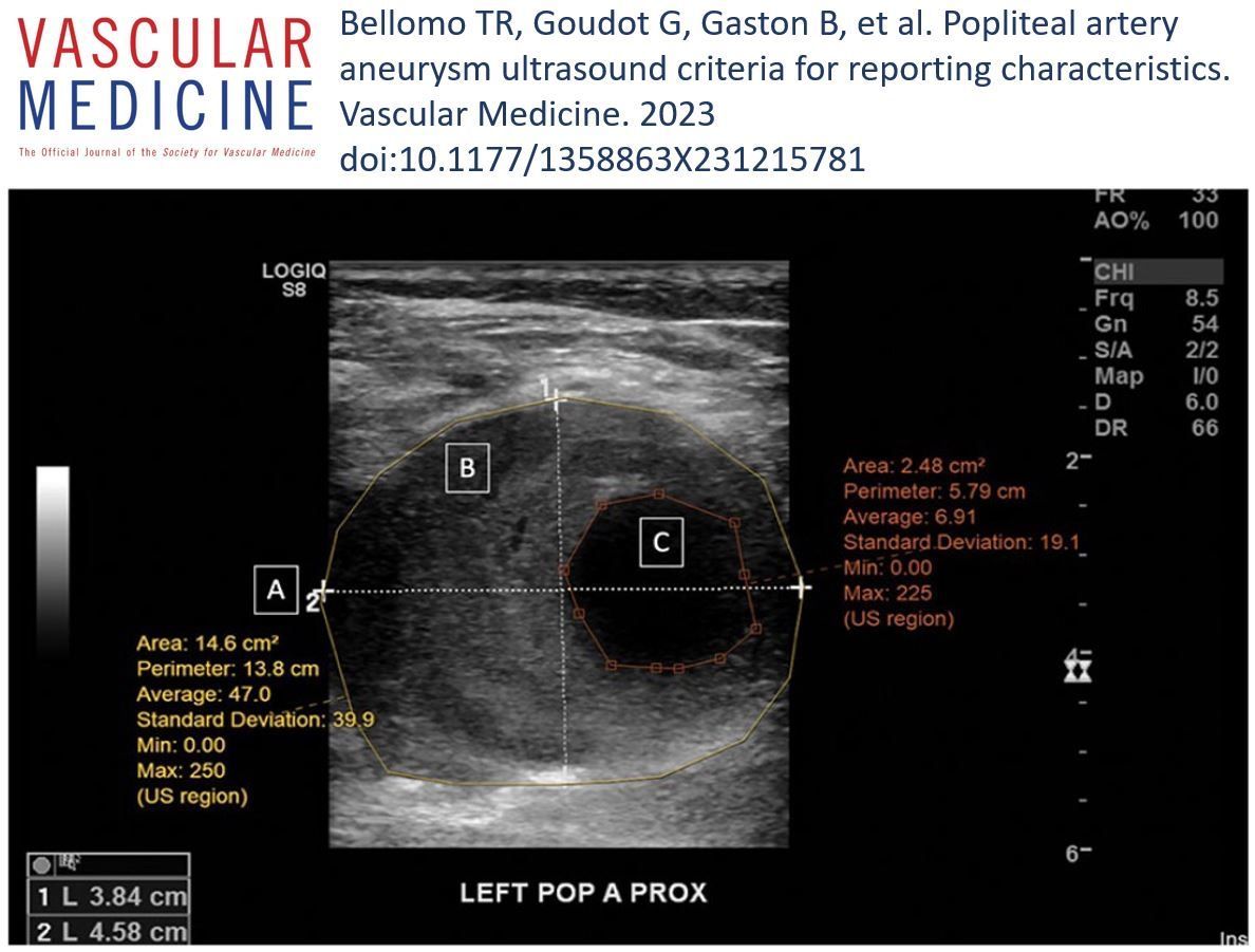 In the latest issue: @BellomoTiffany @AnahitaDua and colleagues report that popliteal artery aneurysms are often not surveyed at recommended intervals and duplex ultrasound reports frequently lack necessary measurements to make clinical decisions. buff.ly/3U3PASu