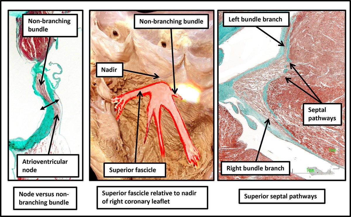ZHeart11768530's tweet photo. 🔴 The Clinical Anatomy of the Atrioventricular Conduction Axis 
💥💥#openAccess Updated #2024Review of the AV conduction system of the heart.

https://t.co/MsQM1l4En4
#cardiology #CardioTwitter #CardioEd https://t.co/5dGsb8e9j8