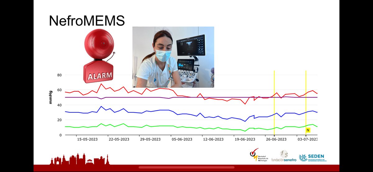 Honoured to talk about the usefulness of #PoCUS in #homedialysis, #congestion and more with @claudiayus @nuriaareste @MaiteGorrin @jmanriquees in the #DPHDD24 @SENefrologia @hgermanstrias @nfrgermanstrias @NephroP @ArgaizR